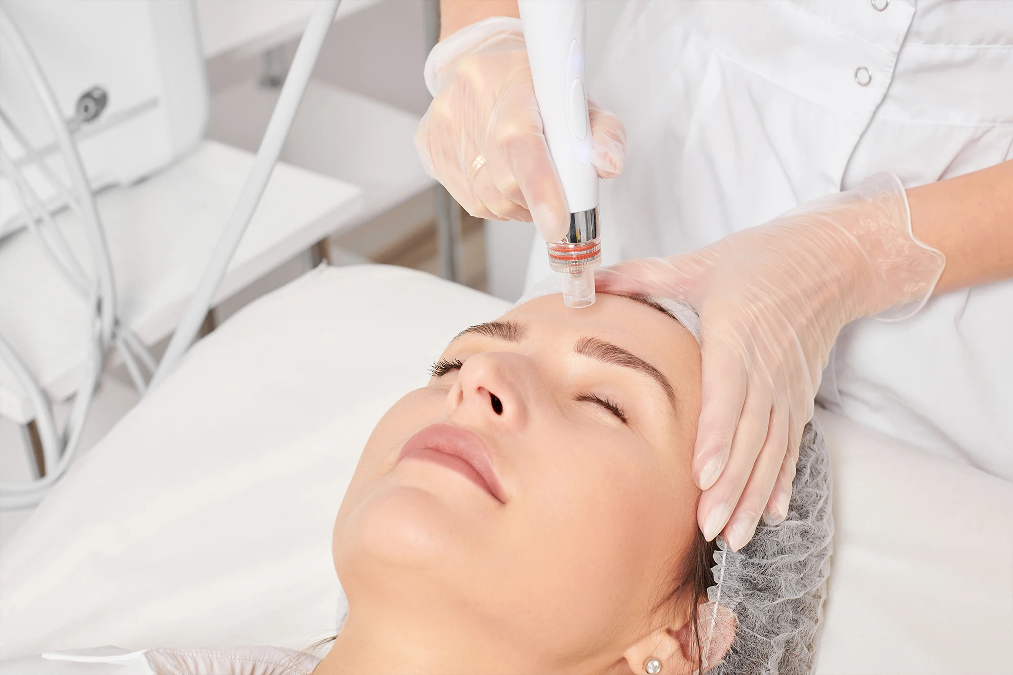 Microneedling